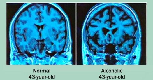 web md alcohol brain
